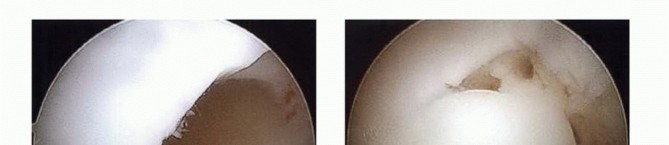 Illustration 35 for Dissecans of the Knee: What's the Difference – OCD vs. AVN?