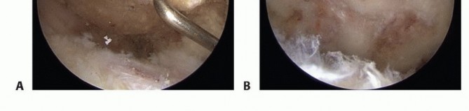 Illustration 14 for Find Relief: Arthroscopic Subacromial Decompression for Impingement