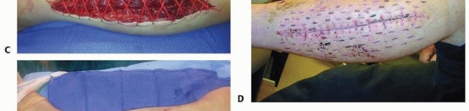 Illustration 24 for Acute Compartment Syndrome: Timely Fasciotomy Explained
