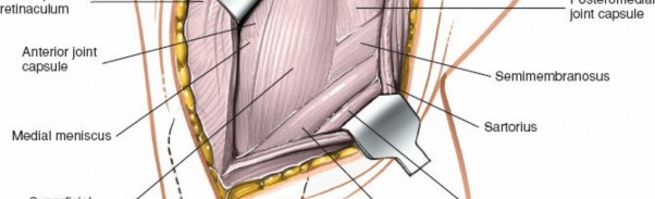 Illustration 71 for Mastering Knee Approaches: Spotlight on Superficial Medial Ligament
