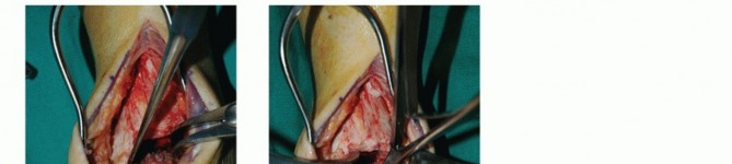 Illustration 14 for Optimize Pain Management with Proximal Ring Block for Ankle Arthrodesis
