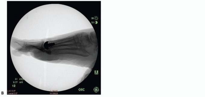 Illustration 53 for End Articular Cartilage Loss: Arthrosurface HemiCAP Resurfacing