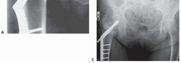 Illustration 25 for ORIF for Peritrochanteric Hip Fractures: Achieve Stable Mobility