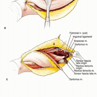 Illustration 18 for Limb-Sparing Quadriceps Resection: Superficial Femoral Artery