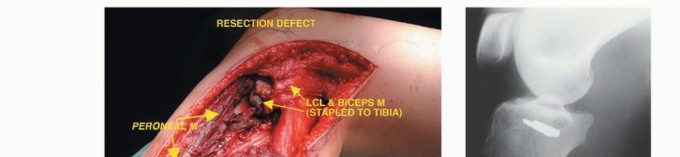 Illustration 26 for Beyond Amputation: The Type I Resection in Fibular Tumor Surgery