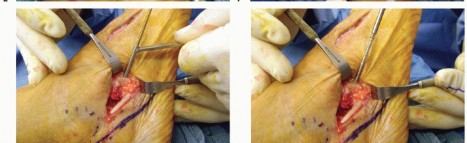 Illustration 22 for Lateral Column Lengthening: Relieve Flatfoot Pain & Correct Deformity