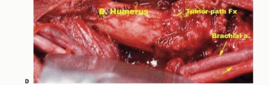 Illustration 14 for Distal Humeral Resection: Safe Techniques for Limb Preservation