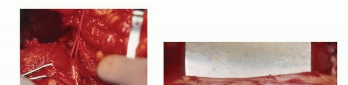 Illustration 20 for Precision Biopsy of Musculoskeletal Tumors for Accurate Diagnosis