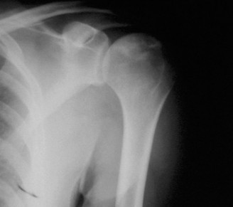 Steroids & Shoulder Pain: Diagnosing AVN of the Humeral Head