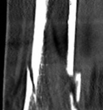 Illustration 12 for Decoding Pilon Fractures: Anterolateral and Medial Fragments Revealed