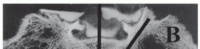 Secure Sacropelvic Fixation: Guiding Screws Toward the AIIS