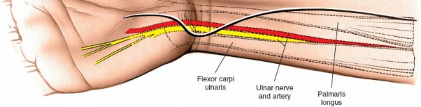 Illustration 44 for Volar Approach: Optimal Exposure for the Volar aspect of the Distal Radius