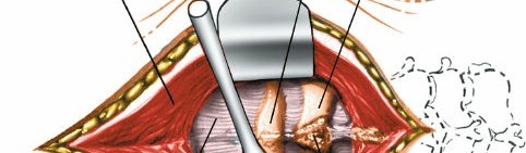 Illustration 229 for Approach to the Lumbar Spine: Mastering Techniques & Anatomy