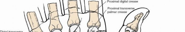 Illustration 82 for Volar Approach: Optimal Exposure for the Volar aspect of the Distal Radius