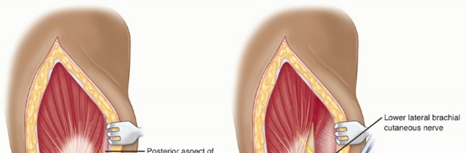 Illustration 20 for Surgical Approaches to Shoulder & Elbow: Pearls and Pitfalls