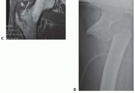 Illustration 2 for ORIF for Peritrochanteric Hip Fractures: Achieve Stable Mobility