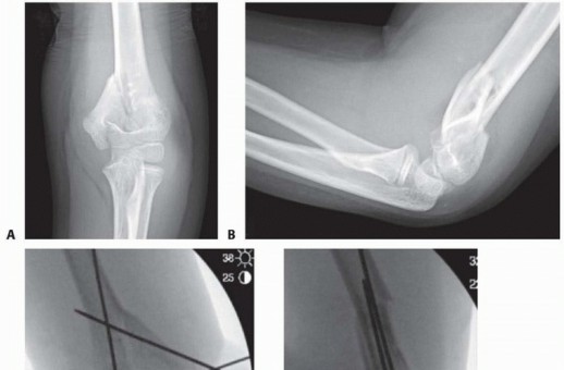 Optimizing ORIF for Pediatric T-Condylar Humerus Fractures