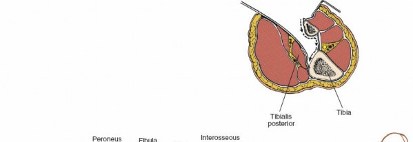 Illustration 86 for Surgical Access: Mastering the Tibia's Surface & Fibula Approaches