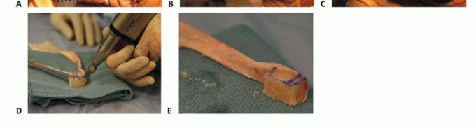 Illustration 10 for Patella Tendon Rupture Reconstruction in Revision TKA