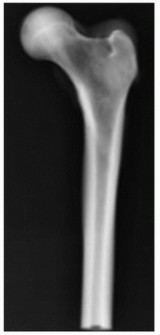 Illustration 5 for Allograft Prosthetic Composite: Mastering Proximal Femur Reconstruction