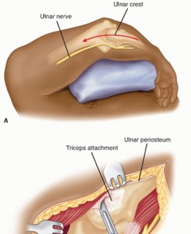Illustration 31 for Surgical Approaches to Shoulder & Elbow: Pearls and Pitfalls