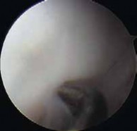 Illustration 40 for Precision Arthroscopy for Chondral Injuries & OCD: Direct Lateral Portal