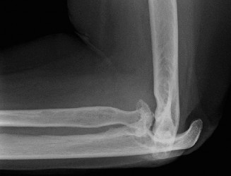 Illustration 82 for Right Shoulder Pain? Avoid This Common X-ray Mistake.
