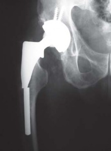 Illustration 39 for The Proxima: Why This Proximally Loading Implant Preserves Bone