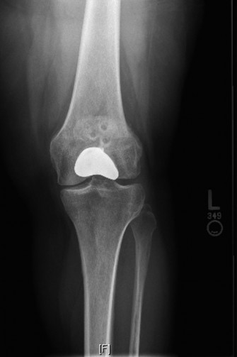 Patellofemoral Arthroplasty: Avoid Failure, End Patellofemoral Pain