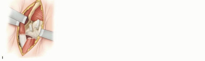 Illustration 15 for Mastering Anterior Open Reduction for Developmentally Dislocated Hip