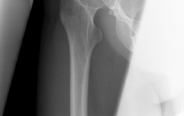 Illustration 6 for Bernese Periacetabular Osteotomy: Your Definitive Case Title Bernese