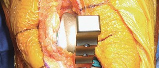 Illustration 50 for Mastering TKA: Essential Methods of Rotational Alignment