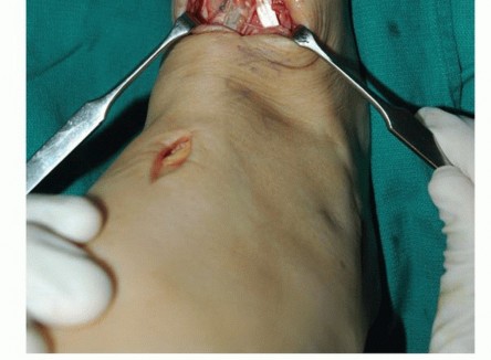 Illustration 56 for Foot Drop Surgery: How a Pin or Drill Elevates Tendon Transfer