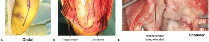 Illustration 28 for Surgical Approaches to Shoulder & Elbow: Pearls and Pitfalls