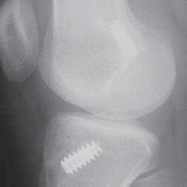 Illustration 94 for Optimizing Single-Bundle Anterior Cruciate Ligament Repair