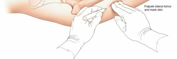 Illustration 65 for Optimal Femoral Approaches: Mastering the Lateral Intermuscular Septum