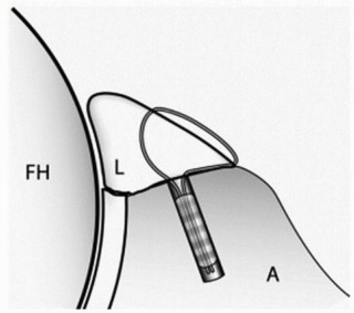 Illustration 26 for Beyond Knee Surg: Hip Arthroscopy for Sports Injuries