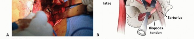Illustration 16 for Restore Hip Health: Pelvic Osteotomy for Acetabular Dysplasia & CEA of Less