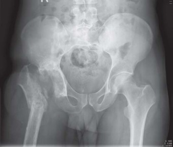 Illustration 22 for THA for patients with proximal femoral deformity: Practical solutions