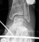 Illustration 6 for Decoding Pilon Fractures: Anterolateral and Medial Fragments Revealed