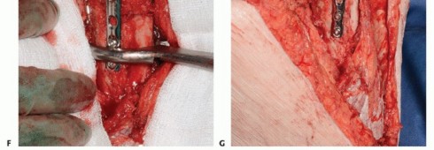 Illustration 41 for Special THA Techniques for Severe Deformities Around the Hip