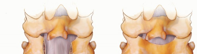 Illustration 14 for Achieve Stability: Posterior Cervical Lateral Mass Screw Fusion