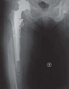 Illustration 64 for S-ROM: Inside the Technique of Modular Implant Design