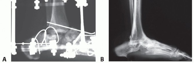 Illustration 24 for Beyond Amputation: Circular Fixation for Infection of the Talus