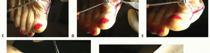 Relieve Hallux Rigidus Pain with Capsular Interpositional Arthroplasty