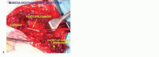 Illustration 17 for Axillary Space Exploration: Surgical Resection of Complex Tumors