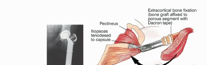 Illustration 48 for Beyond Amputation: Total Femur Resection with Endoprosthetics