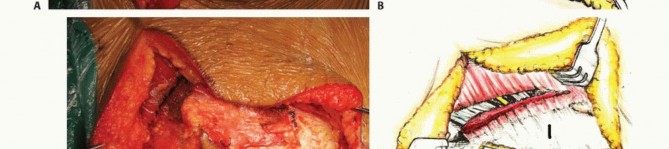 Illustration 29 for Sacral Tumor Surgery: Safeguarding Bowel & Bladder Control