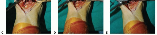 Illustration 13 for Optimize Pain Management with Proximal Ring Block for Ankle Arthrodesis