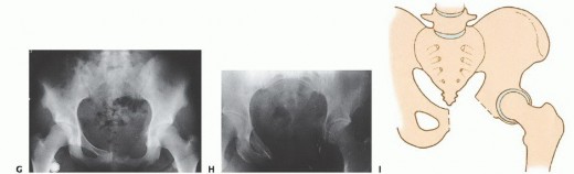 Illustration 16 for Surgical Pelvic Resection: Gluteus Maximus Muscle & Nerve Preservation